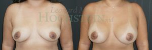 Breast Augmentation Patient 271