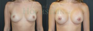 Breast Augmentation Patient