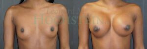 Breast Augmentation Patient 274
