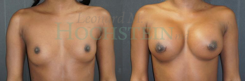 Breast Augmentation Patient