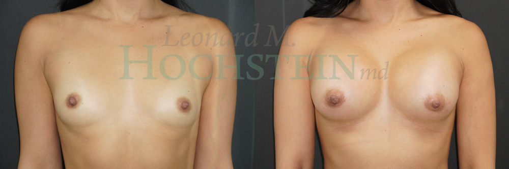 Breast Augmentation Patient
