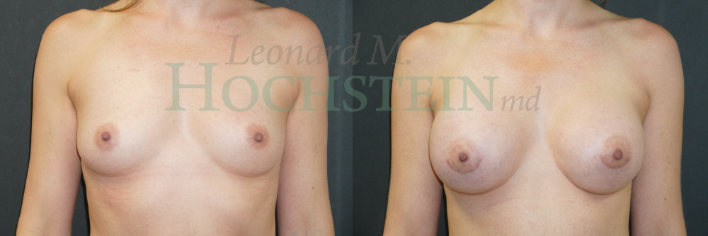 Breast Augmentation Patient