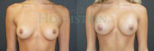 Breast Augmentation Patient