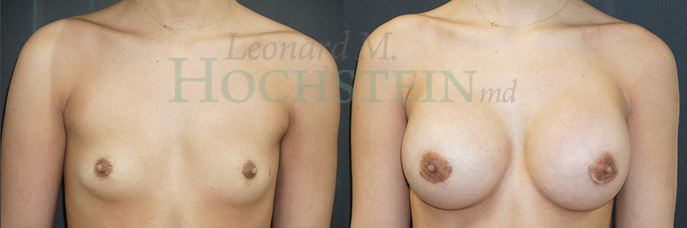 Breast Augmentation Patient