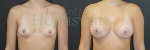 Breast Augmentation Patient 281