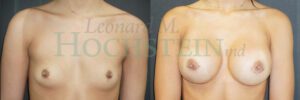 Breast Augmentation Patient 282