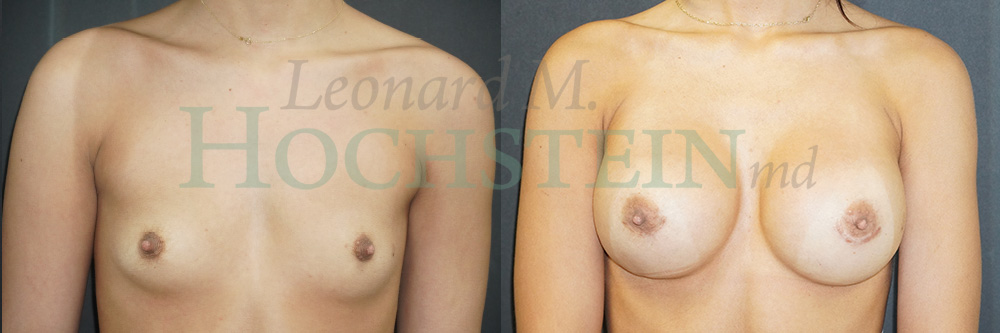 Breast Augmentation Patient
