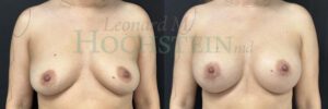 Breast Augmentation Patient 283
