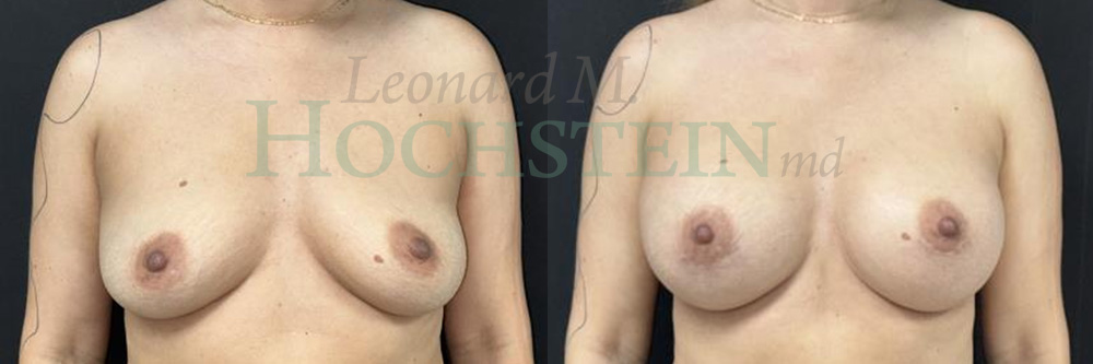 Breast Augmentation Patient