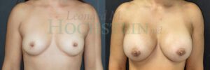Breast Augmentation Patient 284