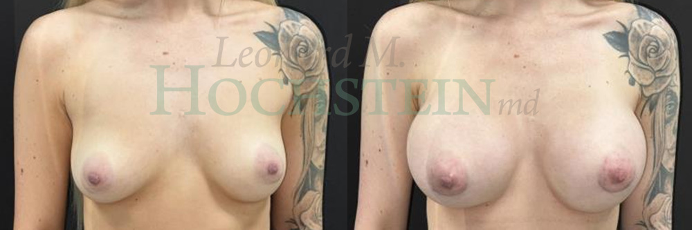 Breast Augmentation Patient