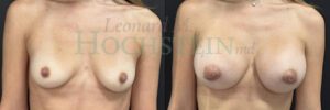 Breast Augmentation Patient 286