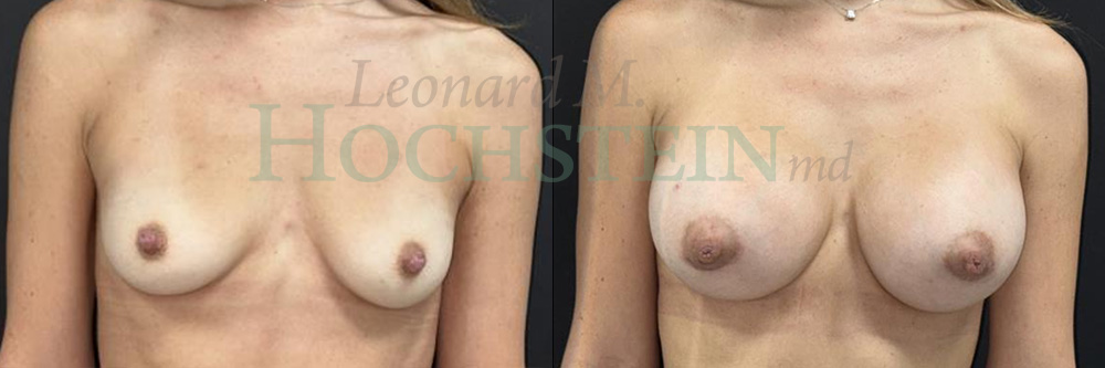 Breast Augmentation Patient