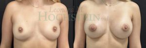 Breast Augmentation Patient 287