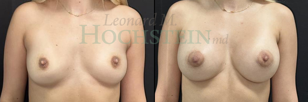 Breast Augmentation Patient