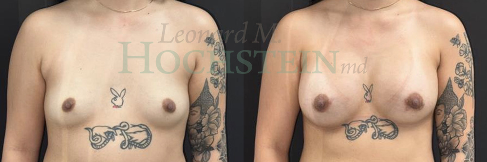 Breast Augmentation Patient