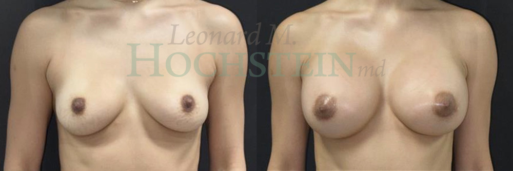Breast Augmentation Patient