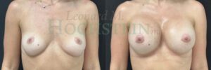 Breast Augmentation Patient 9254
