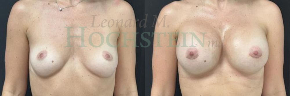 Breast Augmentation Patient