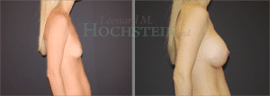 Breast Augmentation Patient