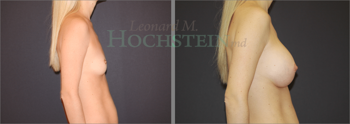 Breast Augmentation Patient
