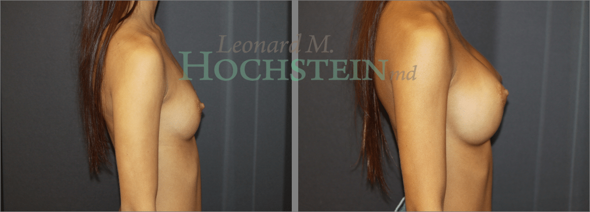 Breast Augmentation Patient