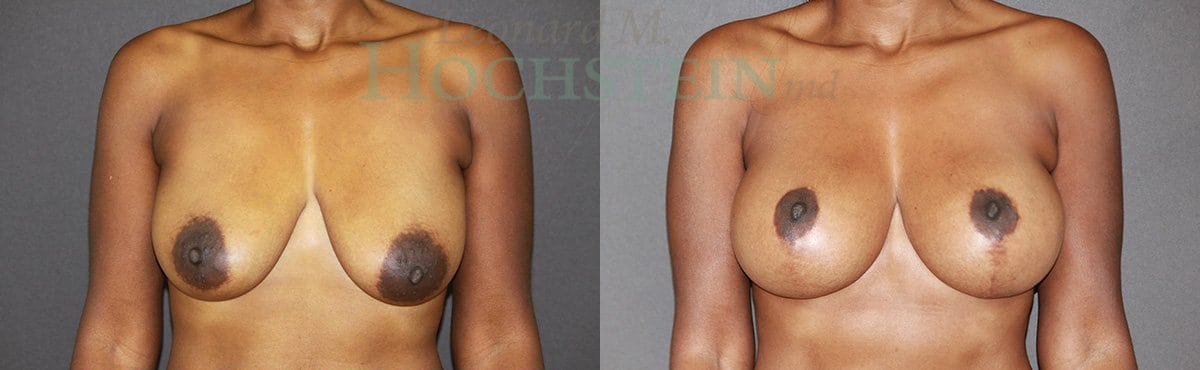 Breast Lift With Implants Patient