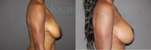 Breast Lift With Implants Patient