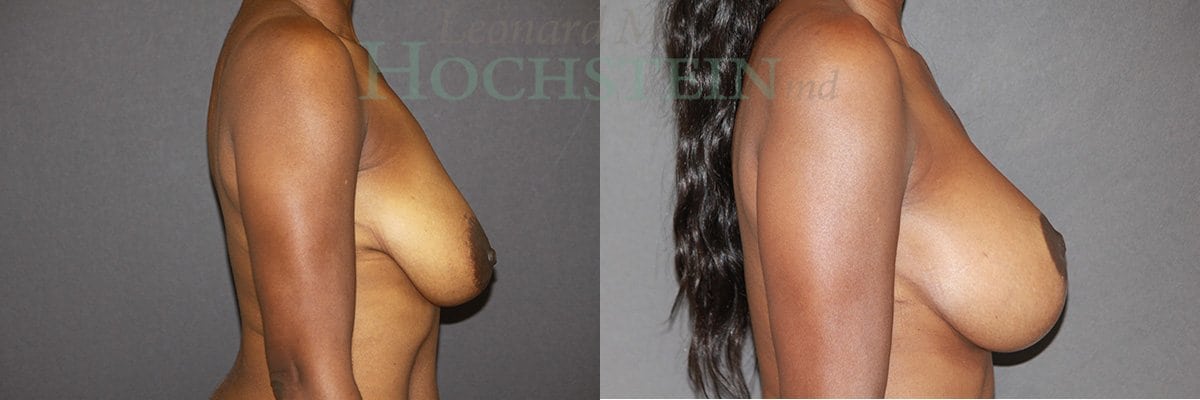 Breast Lift With Implants Patient