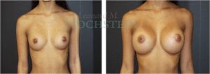 Breast Augmentation Patient