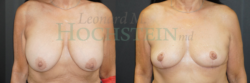 Breast Explant Patient