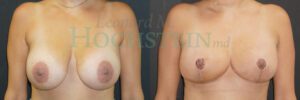 Breast Explant Patient 03