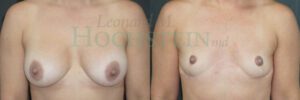 Breast Explant Patient 07