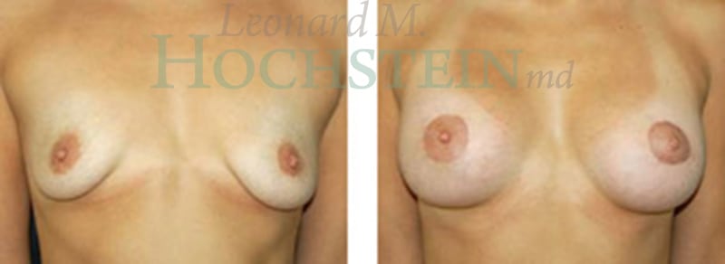 Breast Lift With Implants Patient