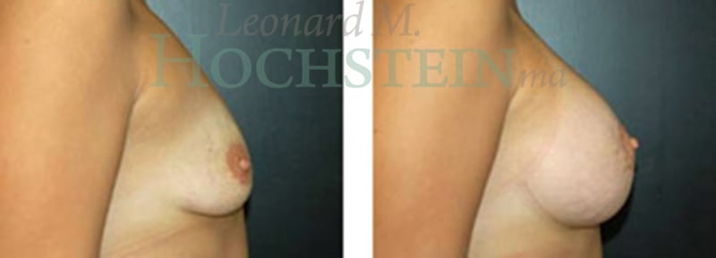 Breast Lift With Implants Patient