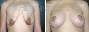 Breast Lift With Implants Patient