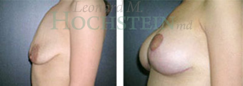 Breast Lift With Implants Patient