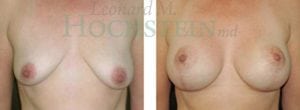 Breast Lift With Implants Patient