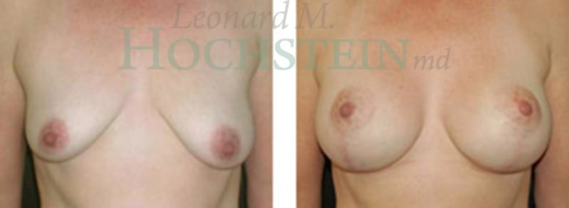 Breast Lift With Implants Patient