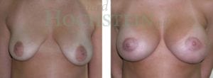 Breast Lift With Implants Patient