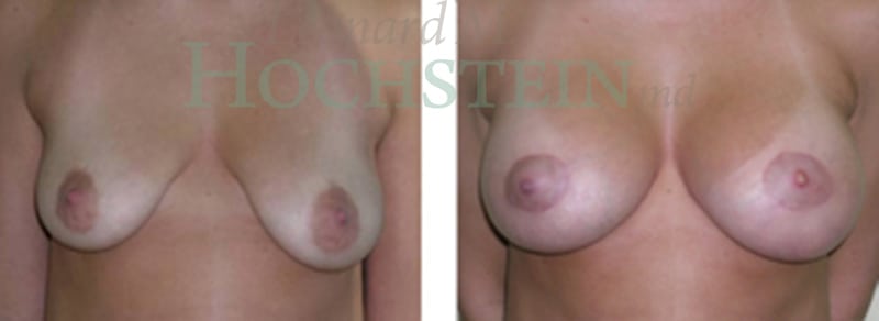 Breast Lift With Implants Patient