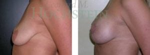 Breast Lift With Implants Patient