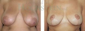 Breast Lift With Implants Patient