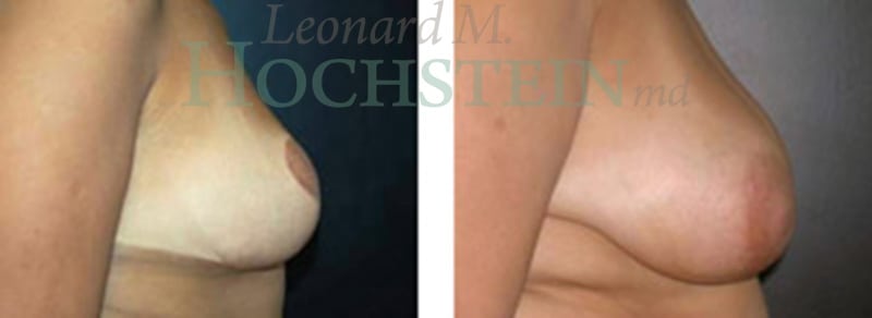 Breast Lift With Implants Patient