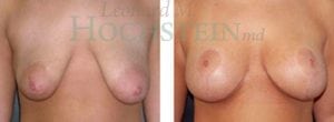 Breast Lift With Implants Patient