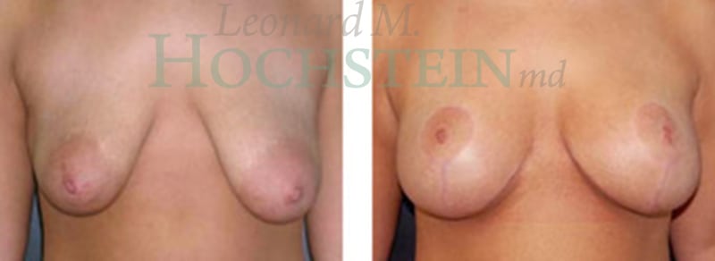 Breast Lift With Implants Patient