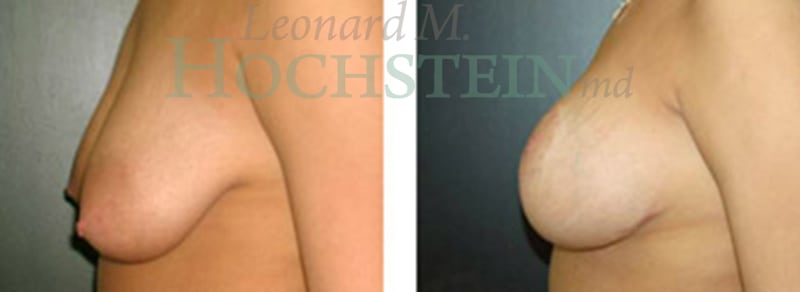 Breast Lift With Implants Patient