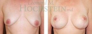 Breast Lift With Implants Patient