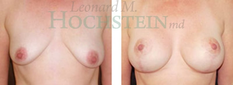 Breast Lift With Implants Patient