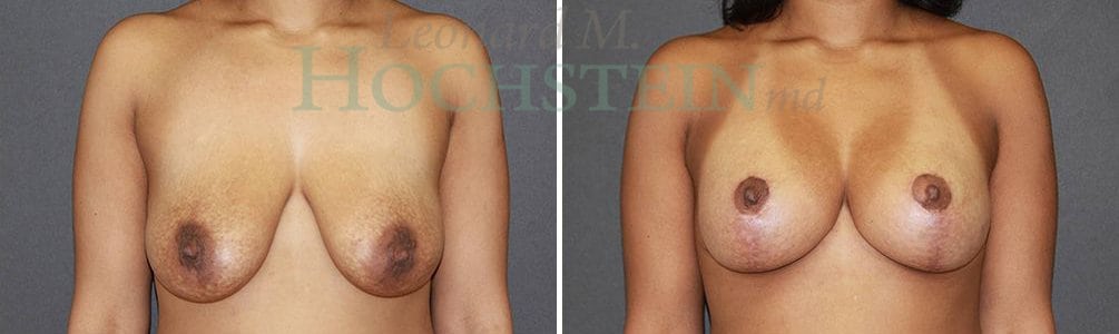 Breast Lift With Implants Patient